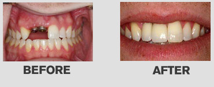 Dental Implants