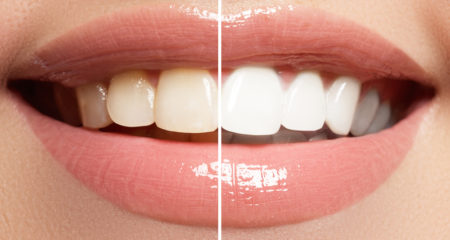 teeth whitening urbandale