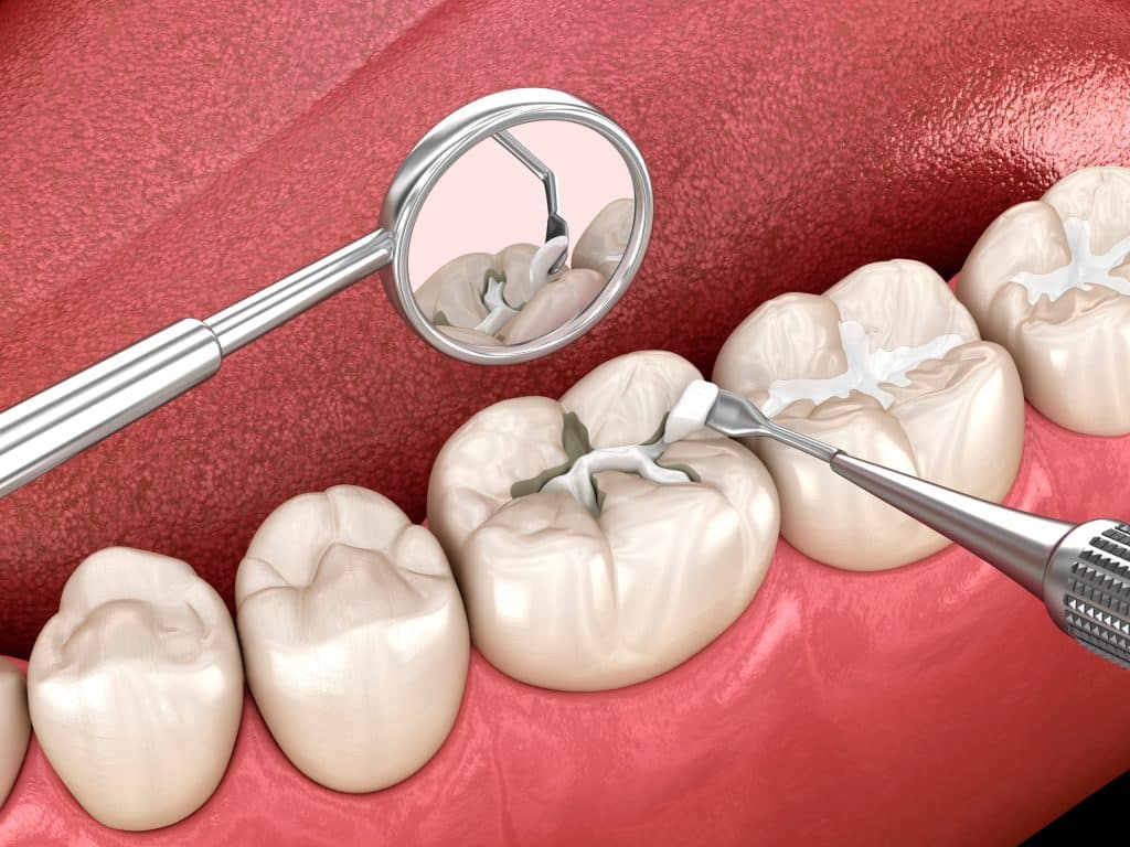 Child receiving dental sealants at a clinic in Urbandale to prevent cavities.