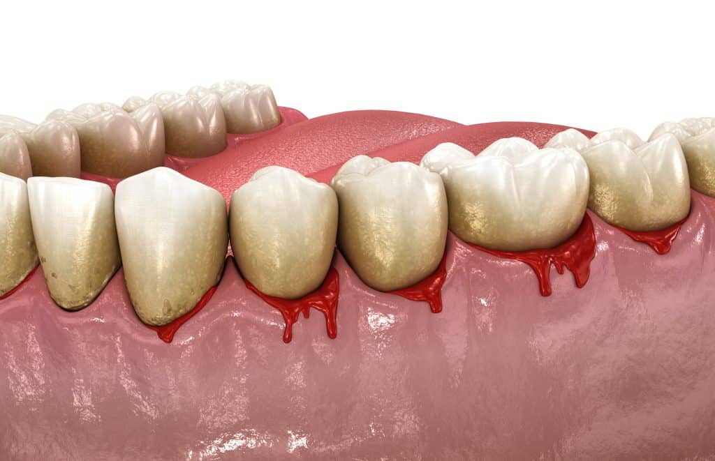 can gum disease be reversed?