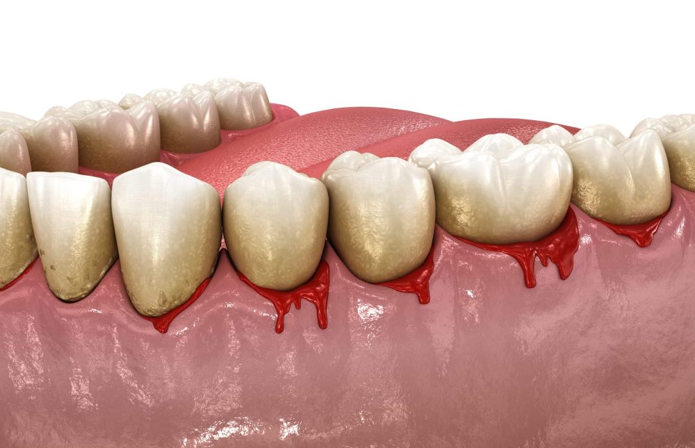 can gum disease be reversed?