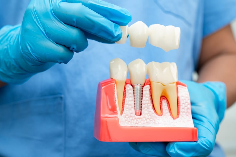 dental implants pros and cons